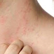 Los Secretos de Gonzalo: La dermatitis atópica
