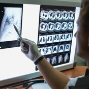 Marca España - Descubrir las claves de la supervivencia al cáncer agresivo - 10/03/25