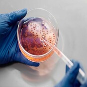 La IA detecta el cáncer de páncreas asintomático